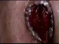 Huge Anal Prolapse Pumping 5m